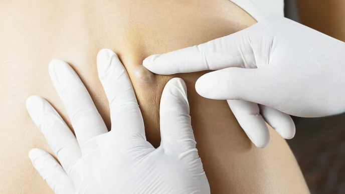 Cirugía de extirpación de quiste – lipoma