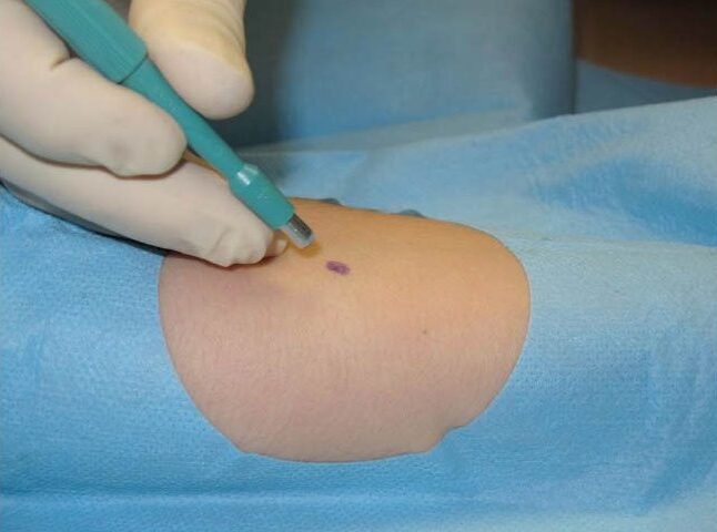 Extracción de piel sin biopsia