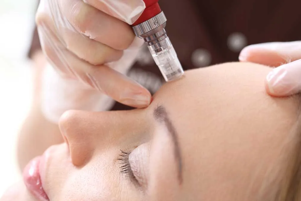 Microagujas en rostro